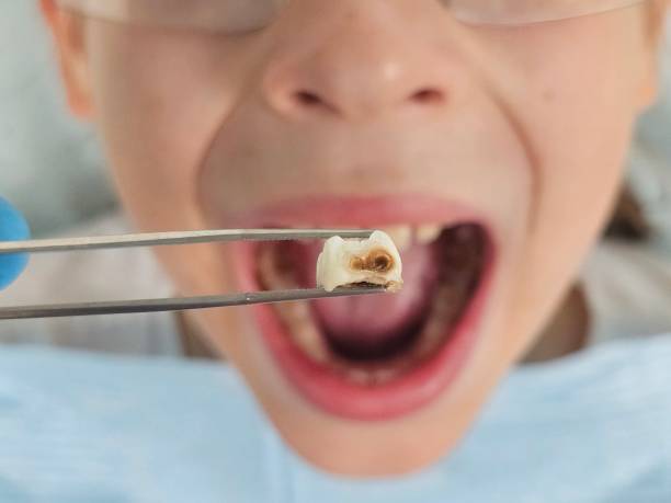Best Emergency Tooth Extraction in Nottingham, PA